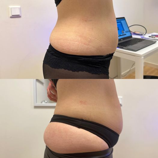 Lipo laser | voor na foto | betere-eter | Emmy Frederiks