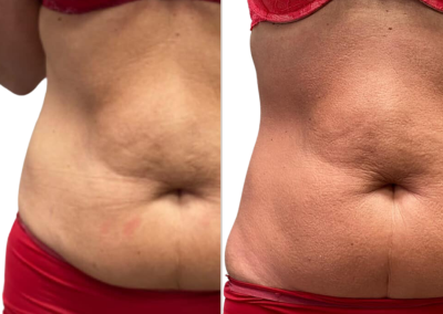 voor en na behandeling bioslimming buik | betere-eter | Emmy Frederiks