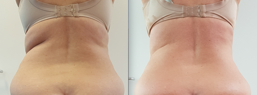 behandeling | betere-eter | Emmy Frederiks