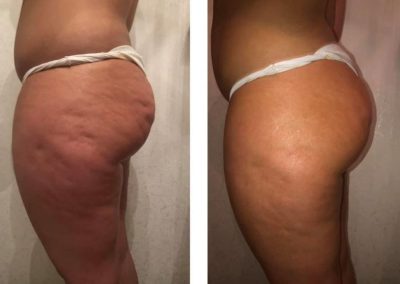 cellulitis behandeling bij Betere Eter