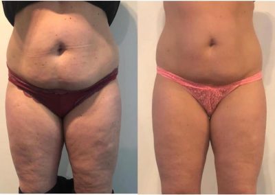 voor- en na behandeling bioslimmen van Betere Eter