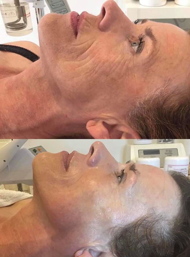 cellulite_betere-eter. 5D kuur betere-eter