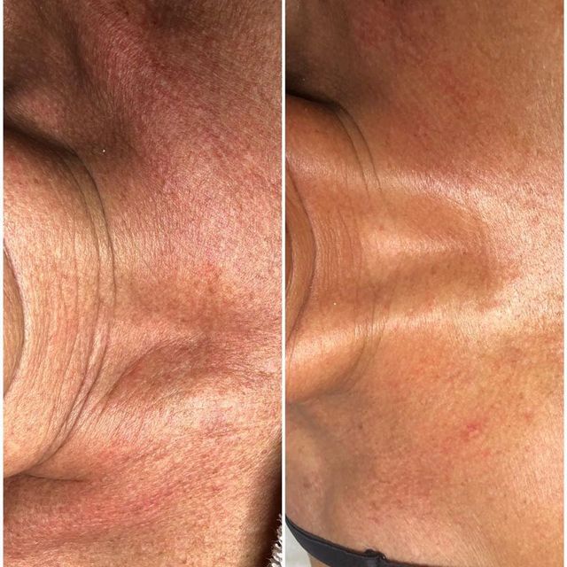 decollete-behandeling-betere-eter